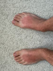 Sunburned feet.